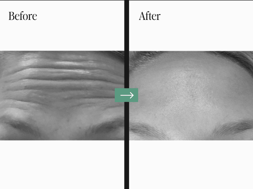 Laser Treatments Before and After Pictures Charleston County, SC